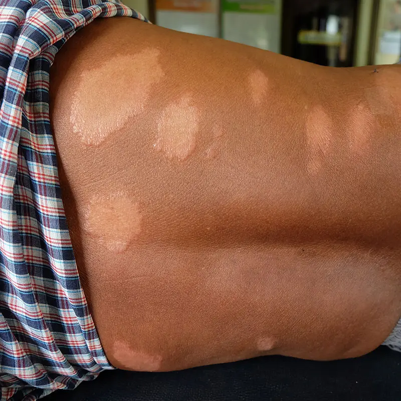 skin of the patient with Leprosy